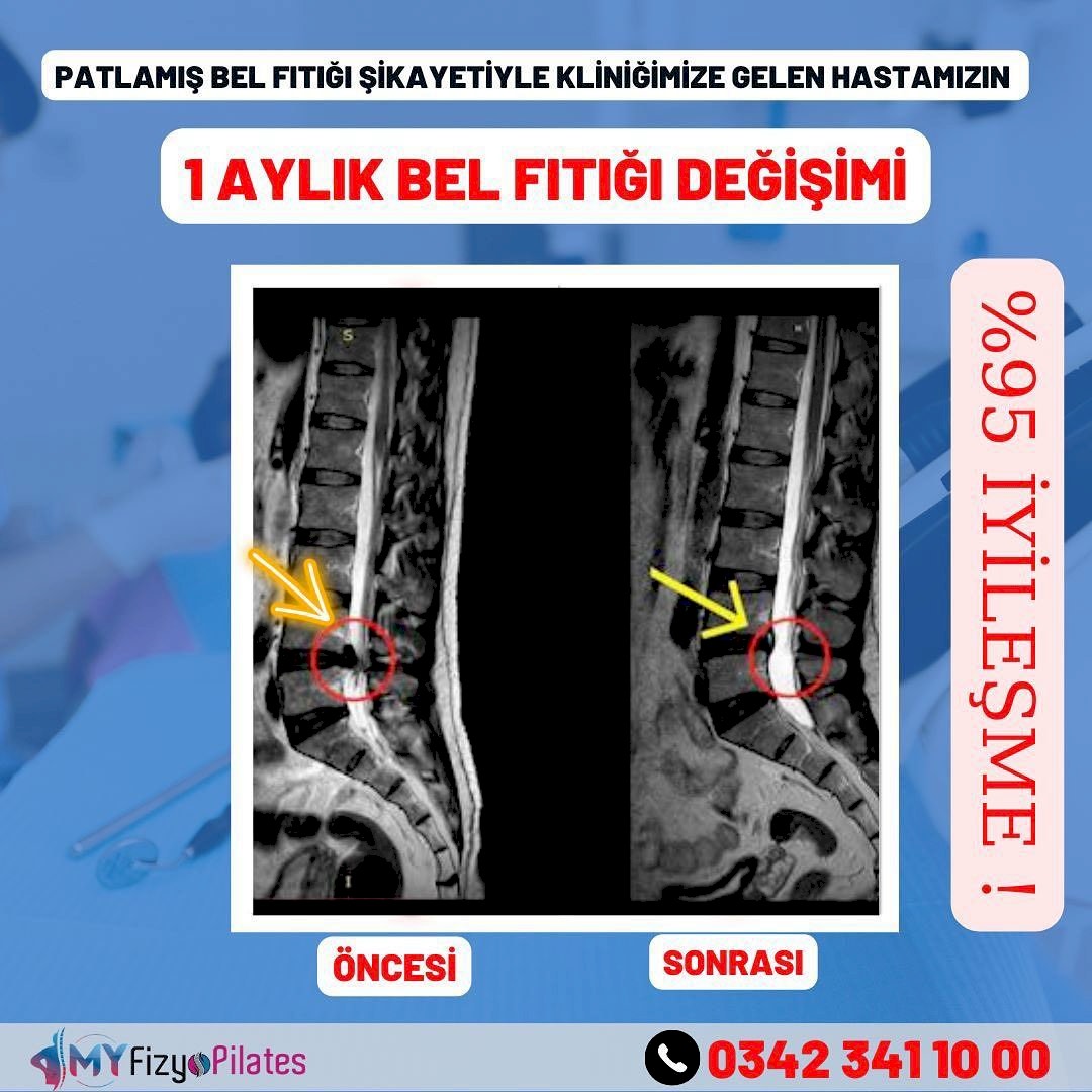 Bel Fıtığı Tedavisi Öncesi Sonrası Görüntü