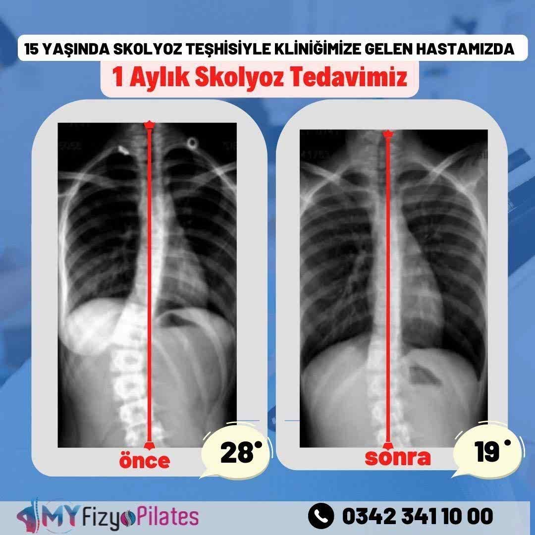 Skolyoz Tedavisi Öncesi Sonrası Görüntü